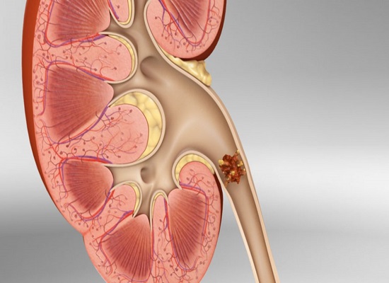 Kidney Stones – Getting rid of them through Ayurveda -