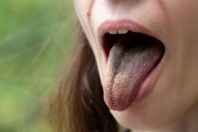 One of the most common and perhaps even primary noticeable symptoms of an unhealthy tongue can be observed when there is a significant change in color from the usual pink.