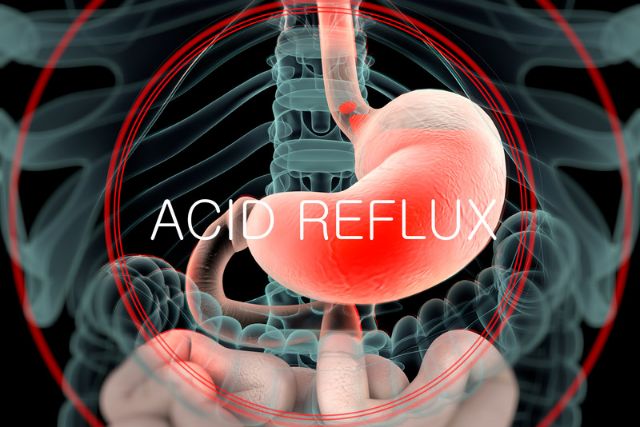 Acid reflux refers to a condition where the digestive acids from your stomach end up in the esophagus 