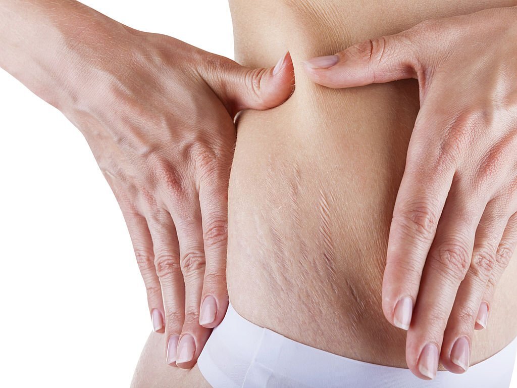 Can Spa Massage Help in Fading Stretch Marks?